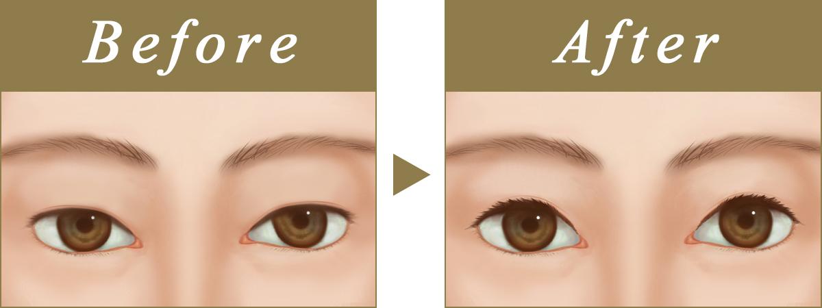上まぶたたるみ切除の完成イメージ（Before / After）