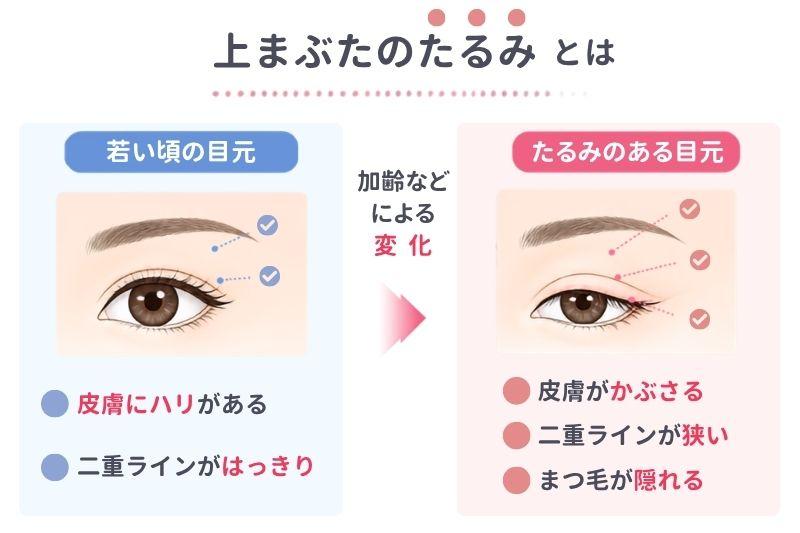 上まぶたたるみ切除
