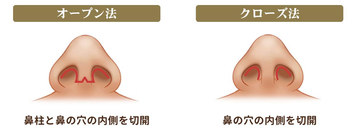 オープン法とクローズ法の切開位置