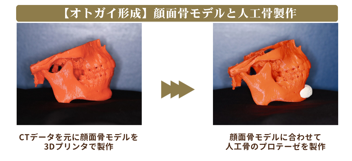 CTデータから製作した顔面骨モデルと人工骨の説明図