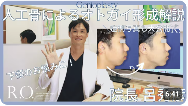 人工骨によるオトガイ形成解説 動画