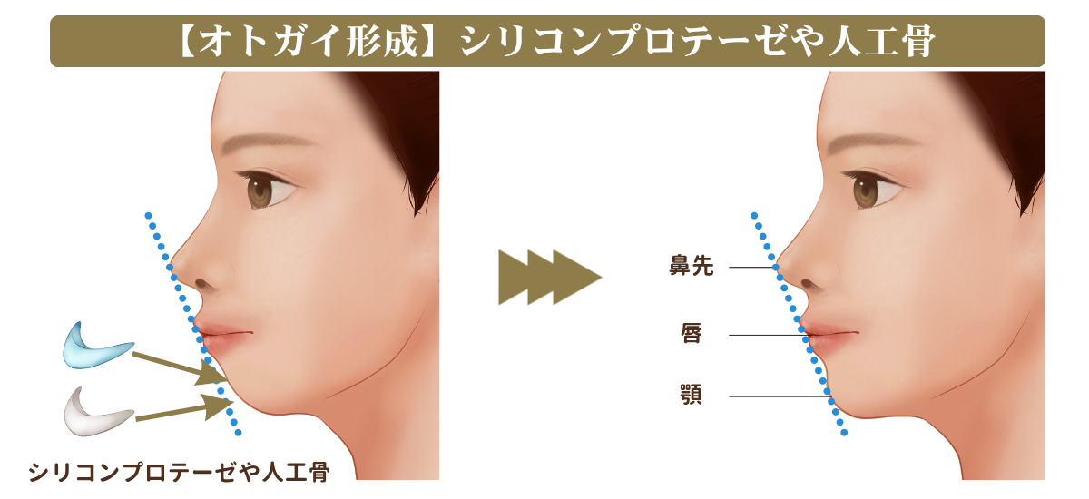 シリコンプロテーゼや人工骨によるオトガイ形成の説明図