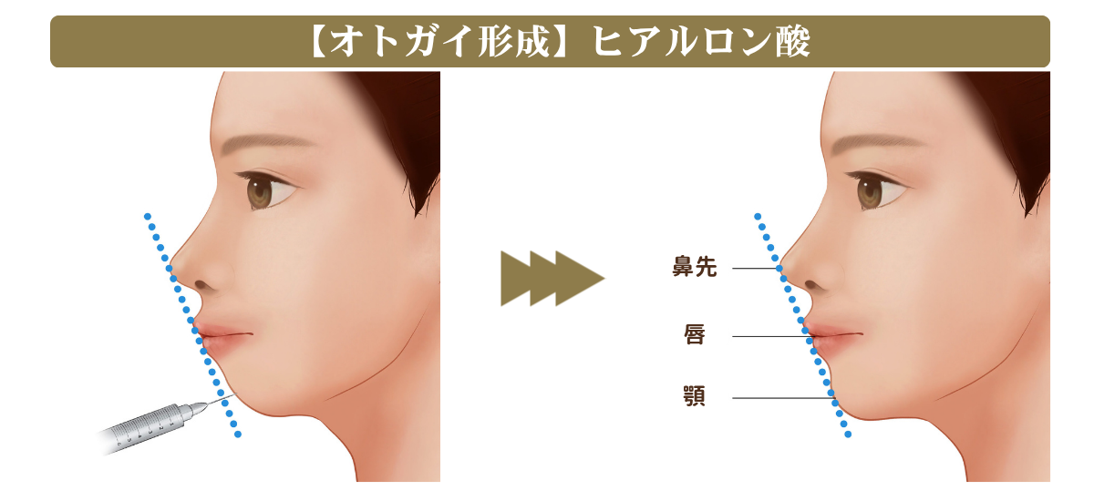 ヒアルロン酸によるオトガイ形成の説明図