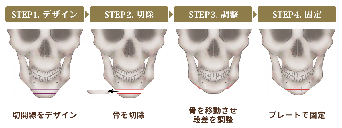 オトガイ骨切り 中抜きの手順
