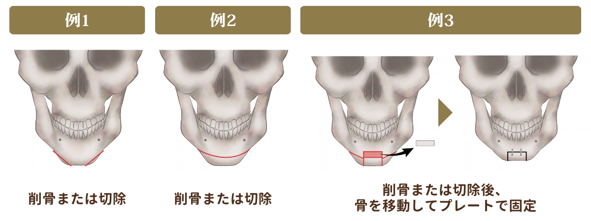 オトガイ骨削り・オトガイ骨切りの説明図