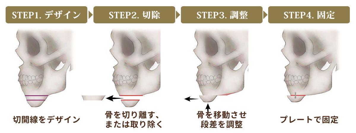 顎先の骨の前方移動の手順