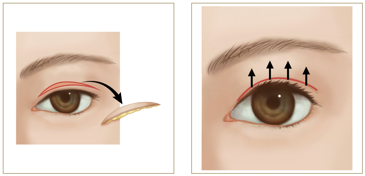 R.O.clinicの上まぶたたるみ切除