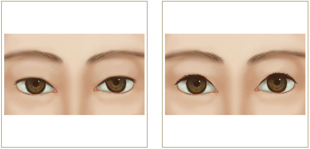 R.O.clinicの上まぶたたるみ切除