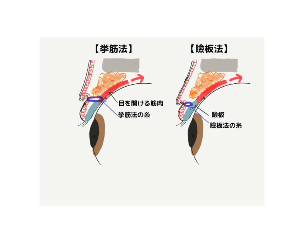 瞼板法と挙筋法について | R.O.clinic | 表参道駅徒歩3分
