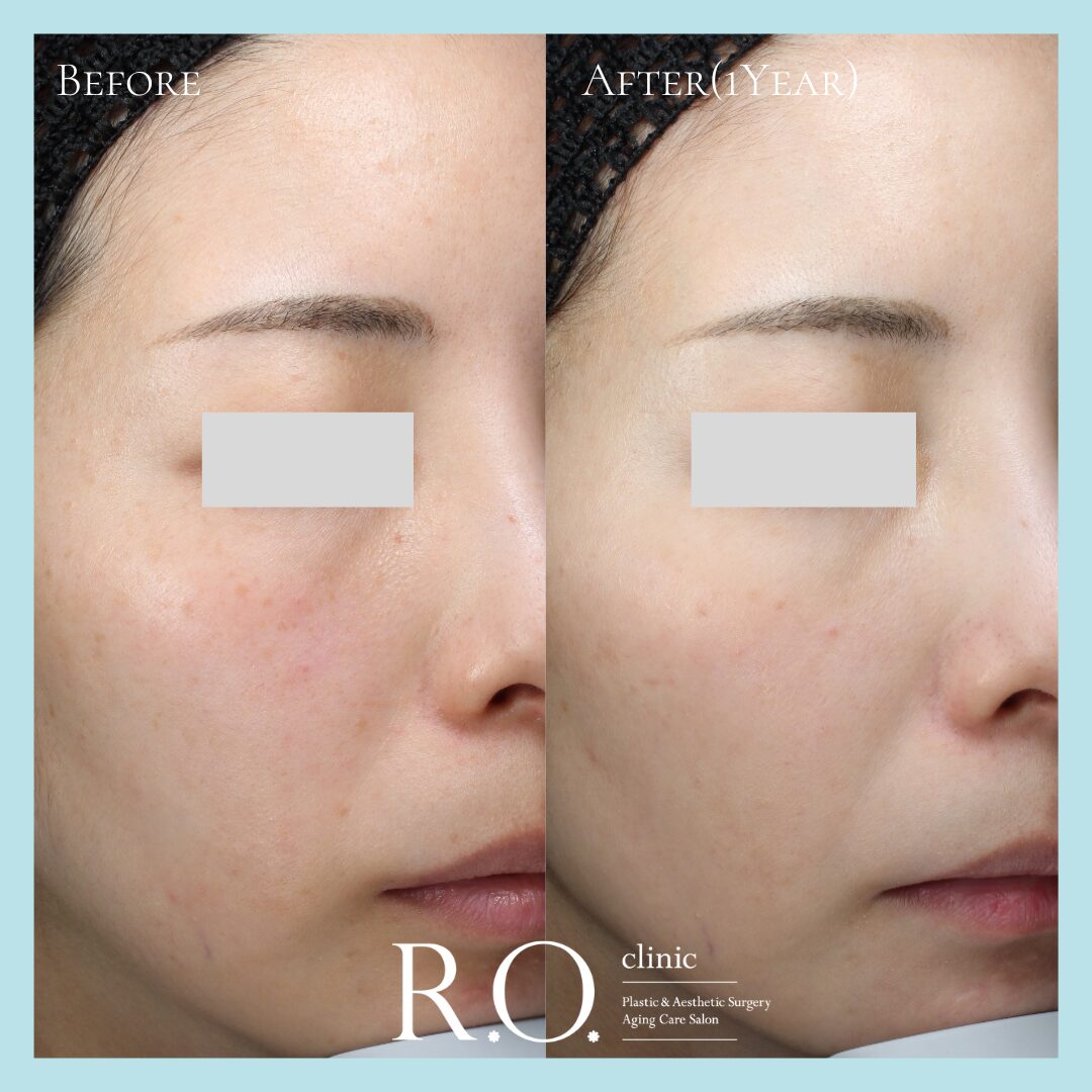 glutathione before surgery Treatment in Turkey glutathione after anesthesia before What