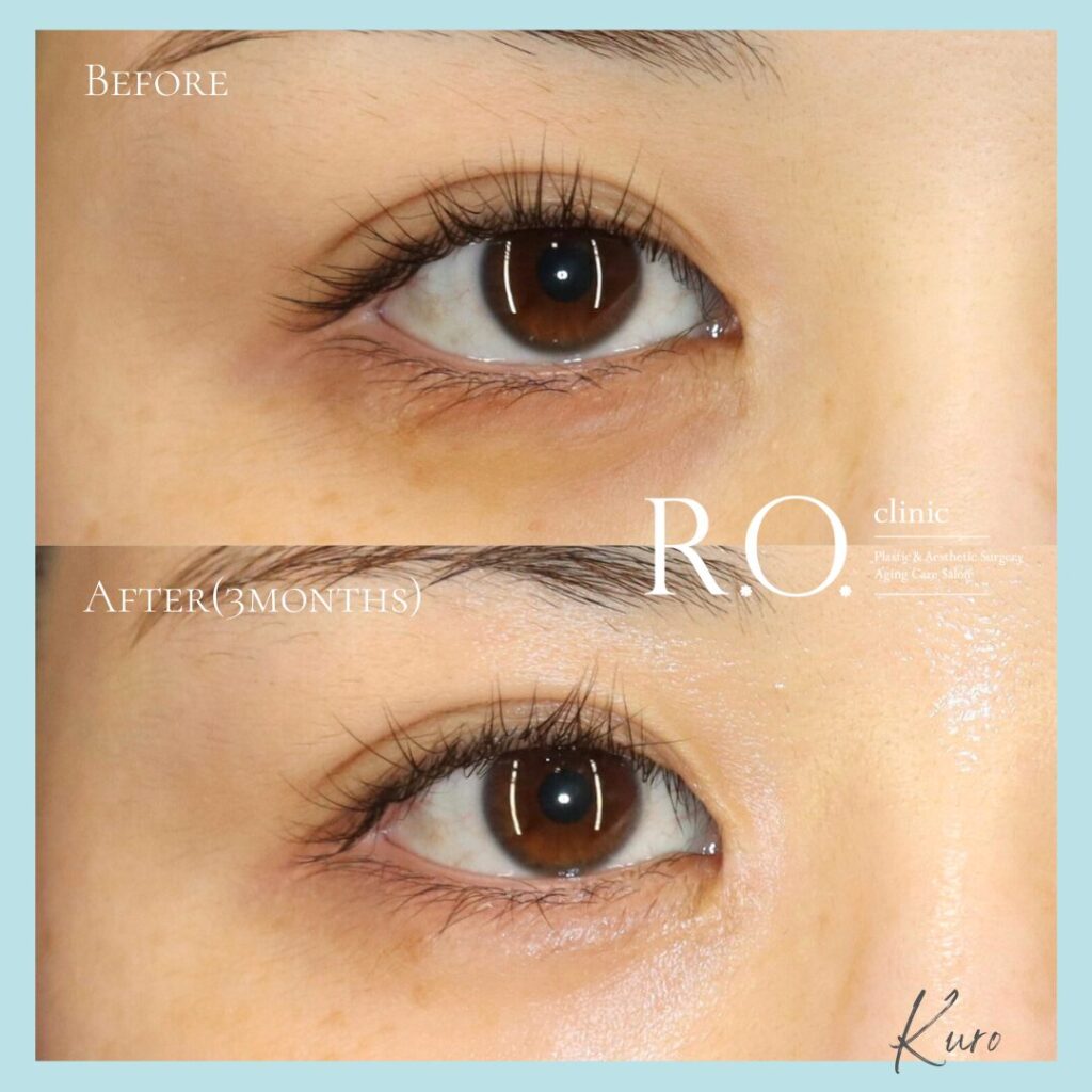 蒙古ひだ形成 VY法