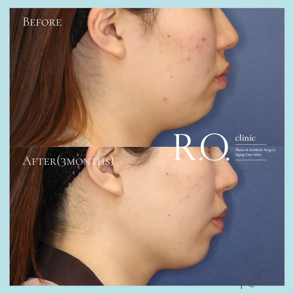 脂肪吸引（両頬・顎下）