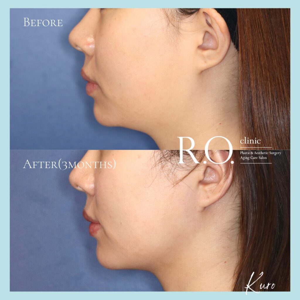 脂肪吸引（顎下）